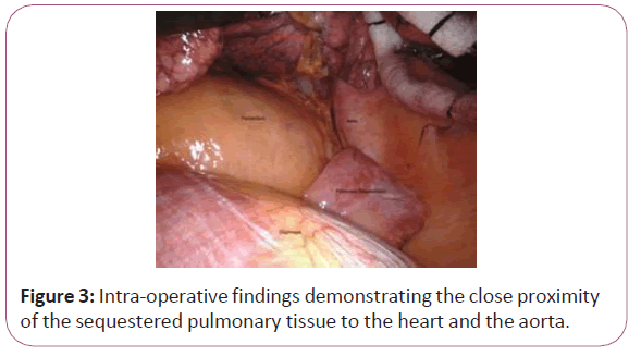 cancer-research-aorta