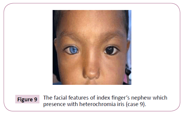 clinical-laboratory-heterochromia-iris