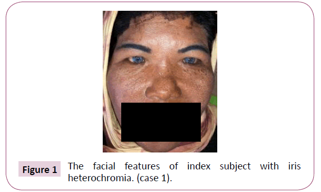 clinical-laboratory-iris-heterochromi