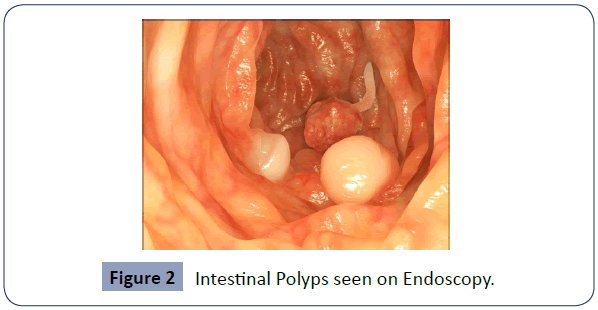 health-science-journal-Polyps