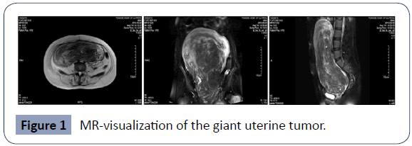 health-science-journal-uterine-tumor