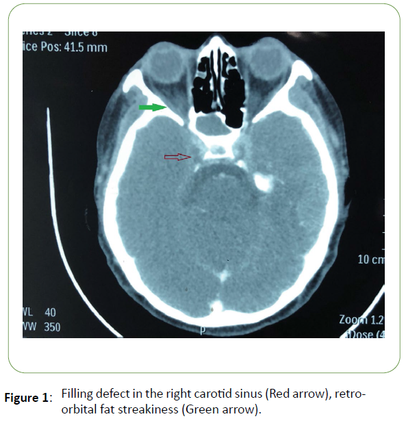 jneuro-carotid-sinus