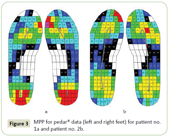 jneuro-mpp-pedar