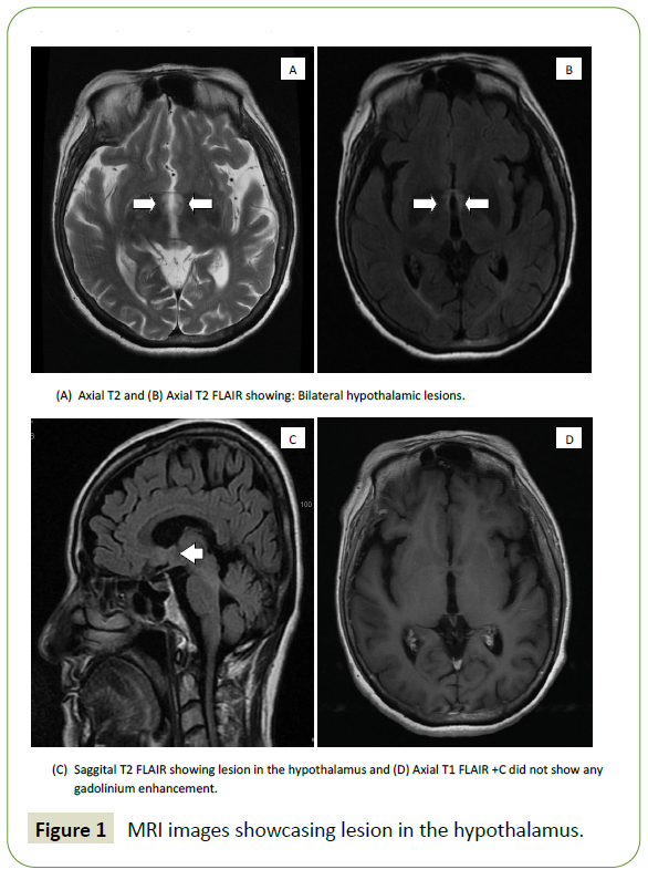 neurology-neuroscience-hypothalamus