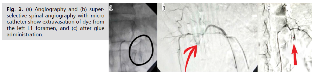 jneuro-angiography