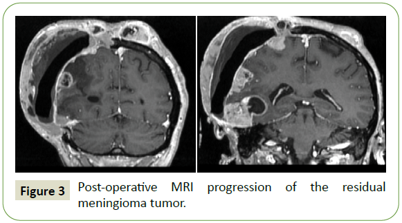neurology-neuroscience-meningioma