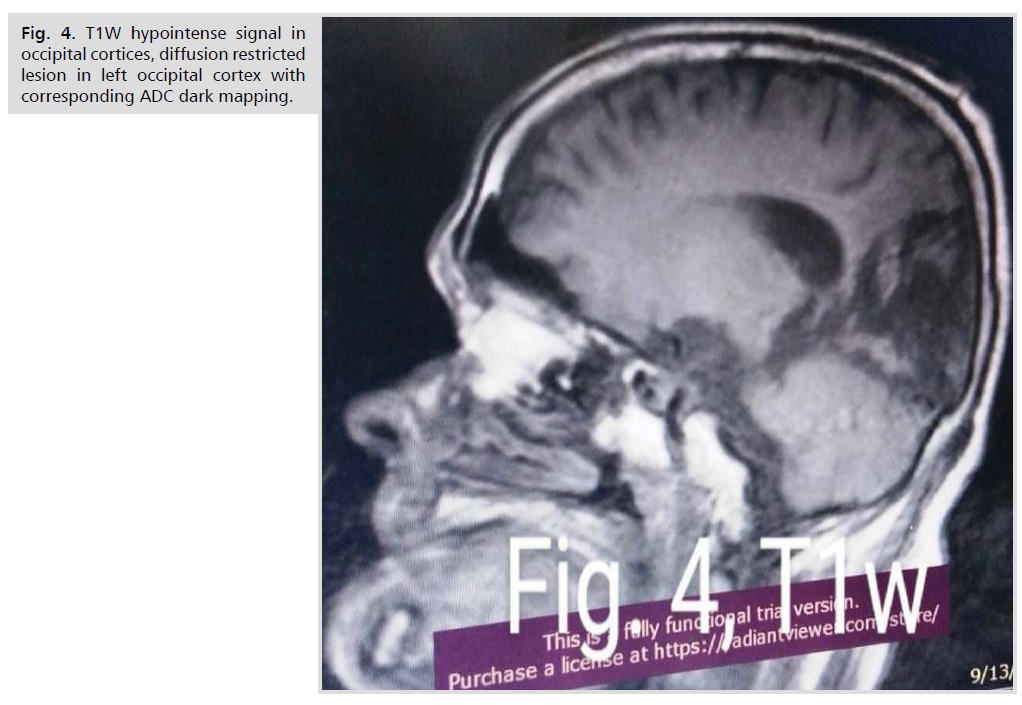 neurology-neuroscience-occipital