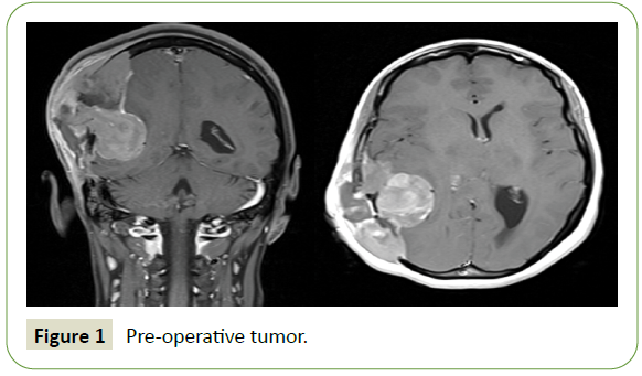 neurology-neuroscience-tumor
