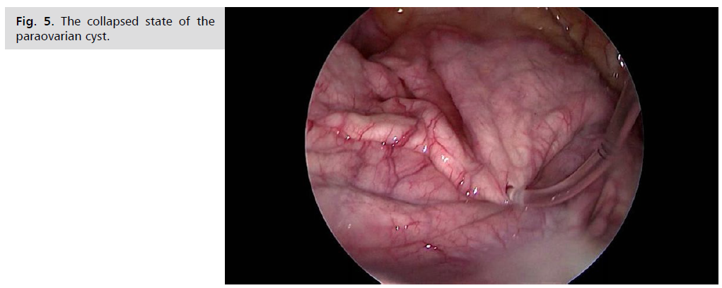 archives-medicine-paraovarian-cyst