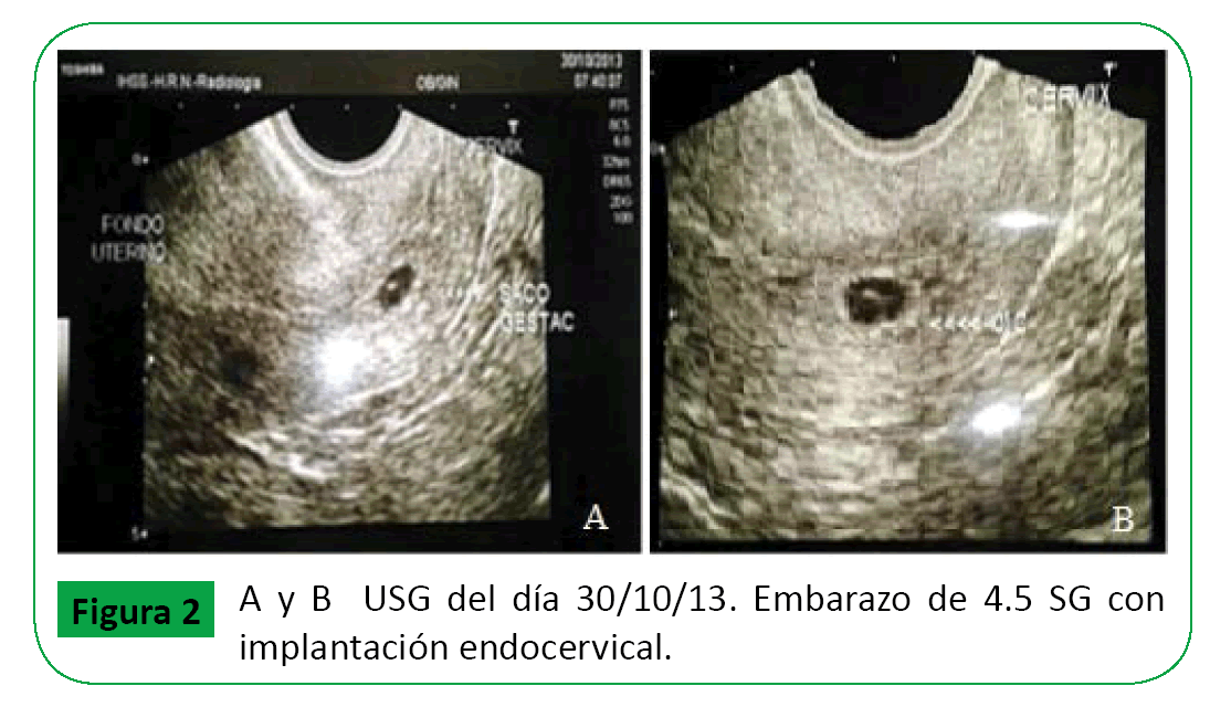ARCHIVOS-DE-MEDICINA-Embarazo-Vitelino-implantacion-endocervical