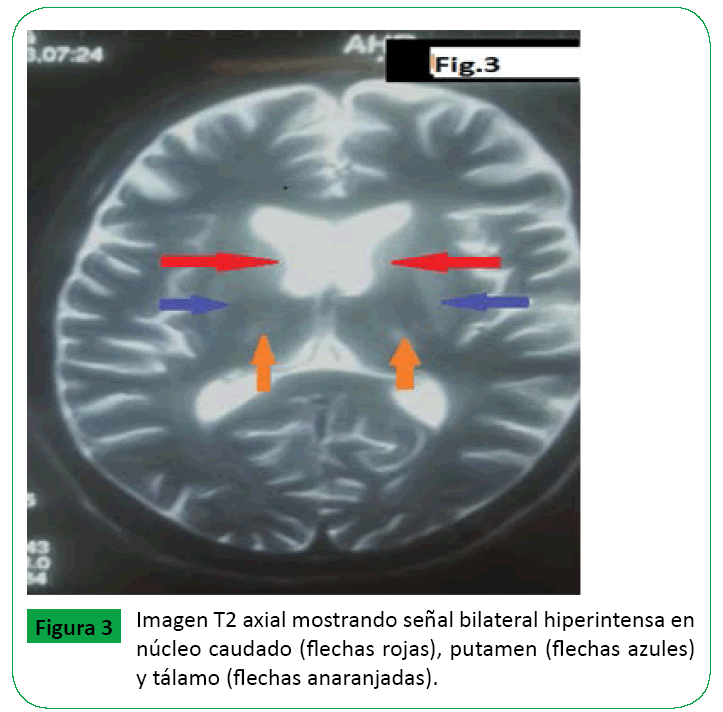 ARCHIVOS-DE-MEDICINA-Imagen-T2-axial-mostrando-senal-hiperintensa