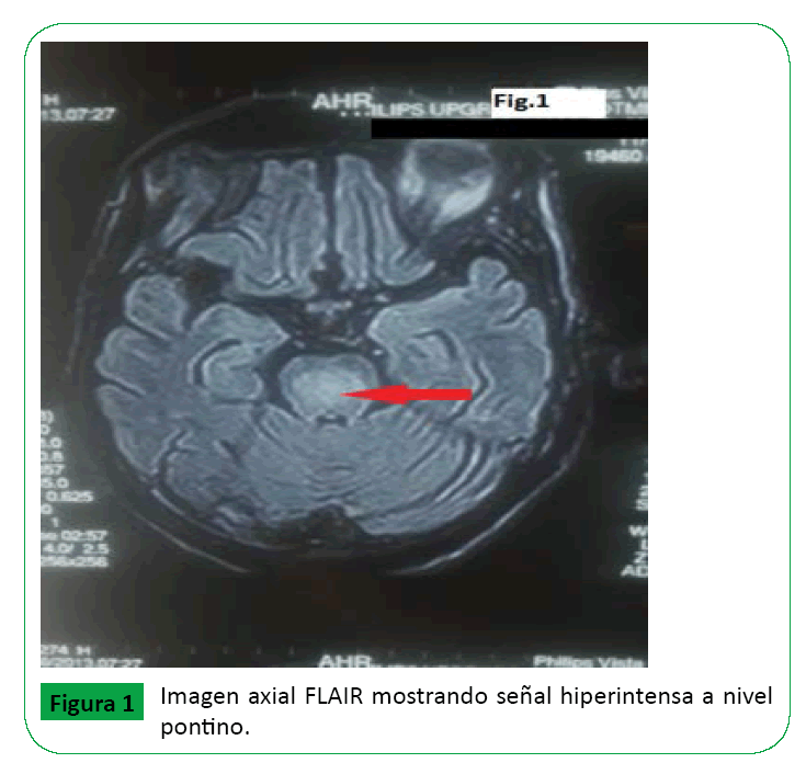 ARCHIVOS-DE-MEDICINA-Imagen-axial-FLAIR-mostrando-senal-hiperintensa