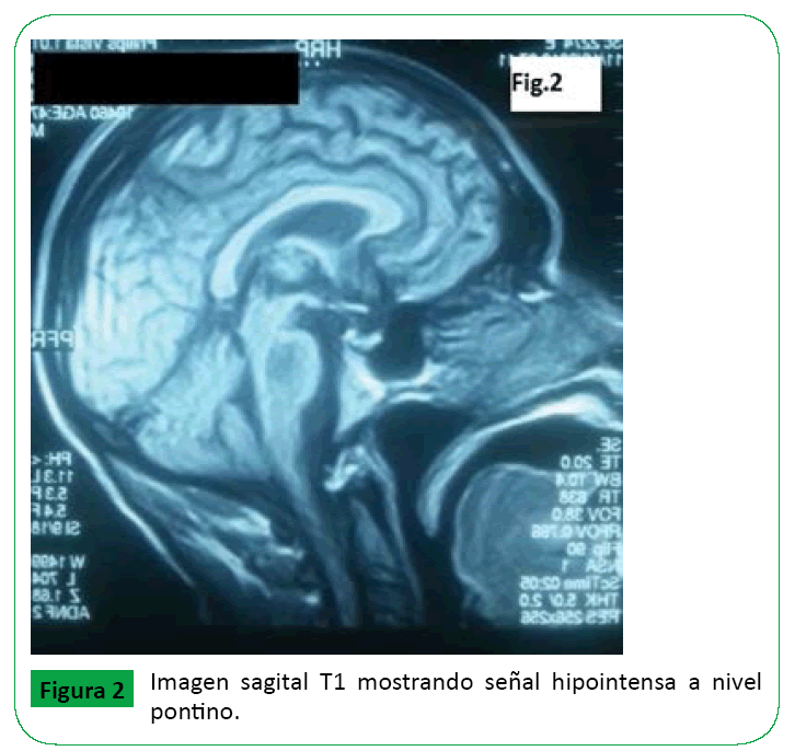 ARCHIVOS-DE-MEDICINA-Imagen-sagital-T1-mostrando-senal-hiperintensa
