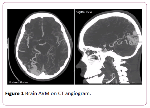 Annals-Clinical-Laboratory-Brain-AVM-CT-angiogram