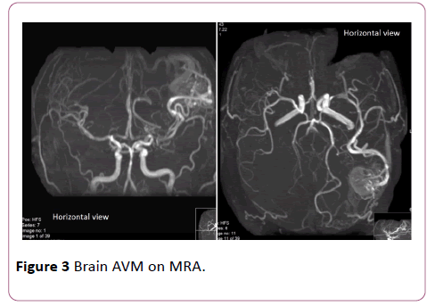 Annals-Clinical-Laboratory-Brain-AVM-MRA