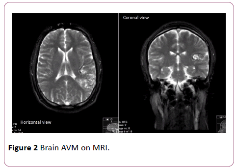 Annals-Clinical-Laboratory-Brain-AVM-MRI