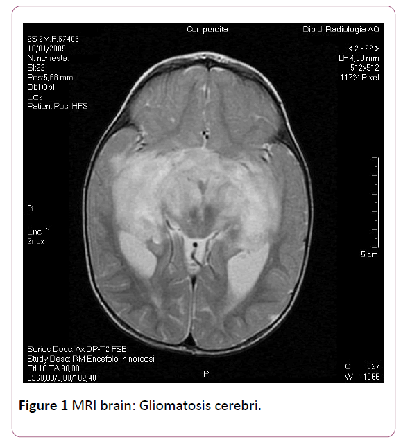 Annals-Clinical-Laboratory-Gliomatosis-cerebri
