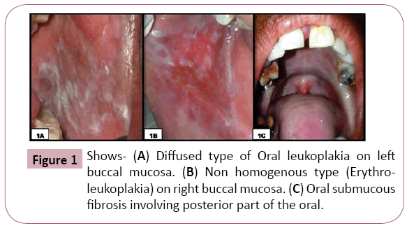 Annals-Clinical-Laboratory-Oral-leukoplakia