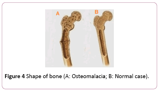 Annals-Clinical-Laboratory-Osteomalacia-Normal