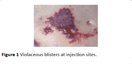 Annals-Clinical-Laboratory-Violaceous-blisters