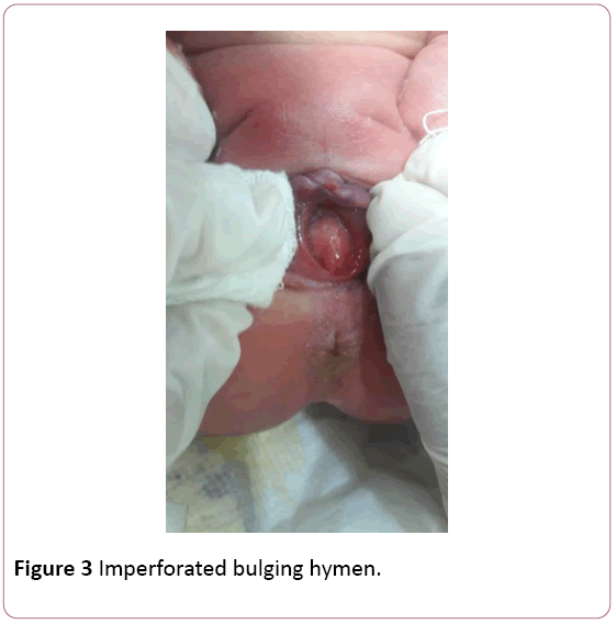 Annals-Clinical-Laboratory-bulging-hymen