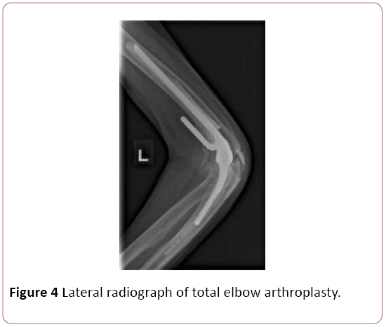 Annals-Clinical-Laboratory-elbow-arthroplasty