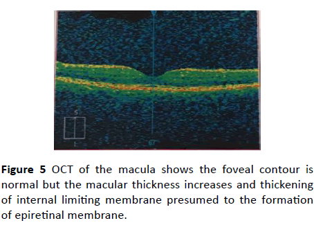 Annals-Clinical-Laboratory-epiretinal-membrane