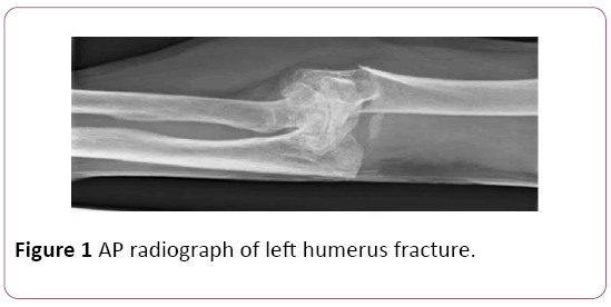 Annals-Clinical-Laboratory-humerus-fracture
