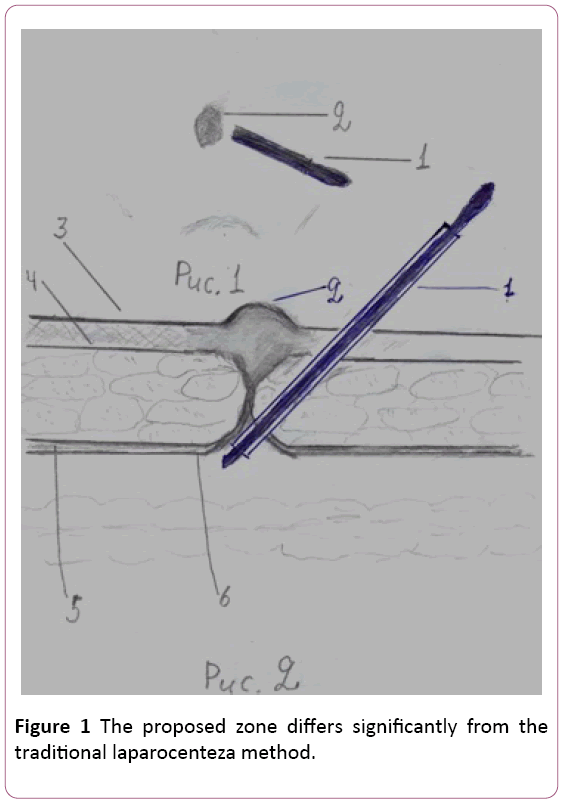 Annals-Clinical-Laboratory-laparocenteza-method