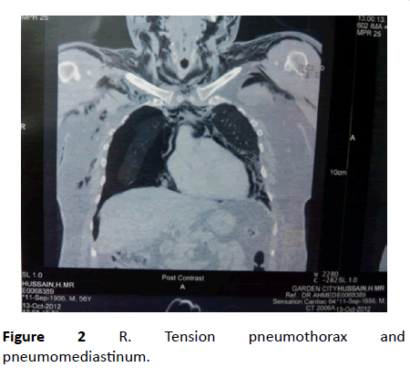 Annals-Clinical-Laboratory-pneumothorax