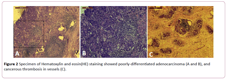 Annals-Clinical-Laboratory-poorly-differentiated-adenocarcinoma