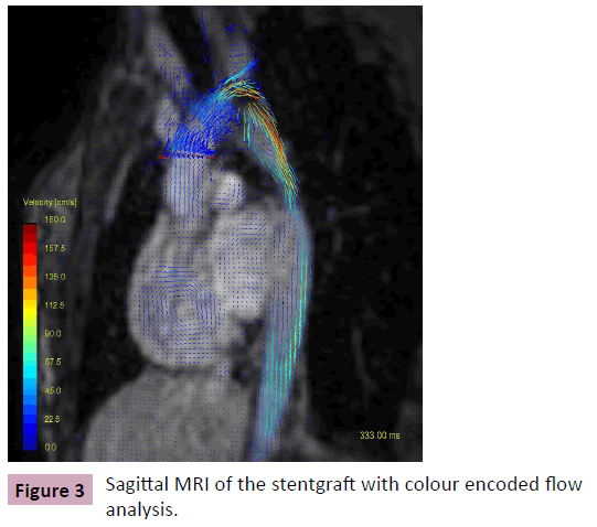 Annals-Clinical-Laboratory-stentgraft-colour-encoded