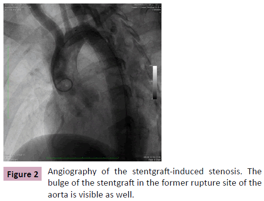 Annals-Clinical-Laboratory-stentgraft-induced