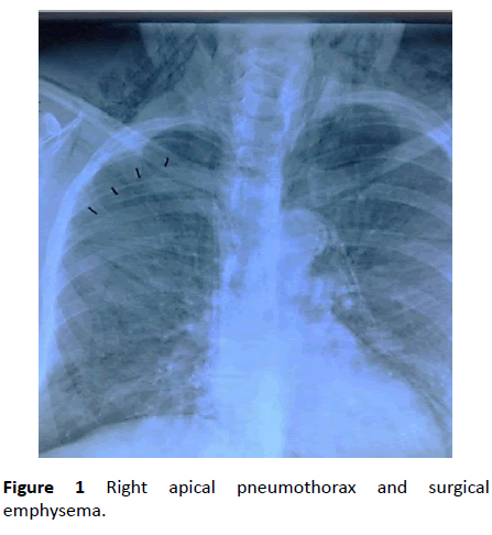 Annals-Clinical-Laboratory-surgical-emphysema