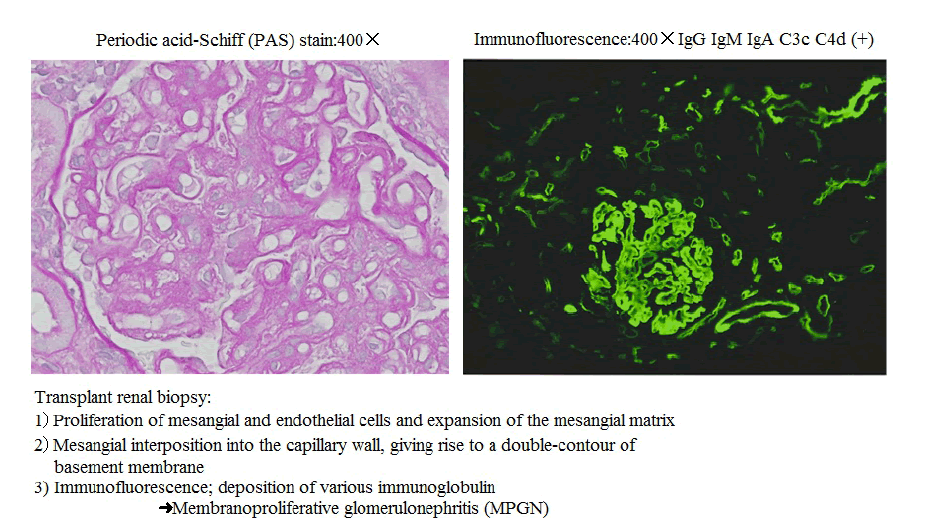 Annals-Clinical-Laboratory-transplant-renal-biopsy