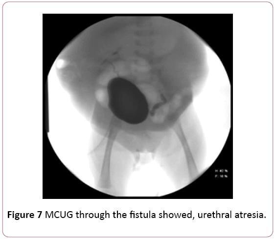 Annals-Clinical-Laboratory-urethral-atresia