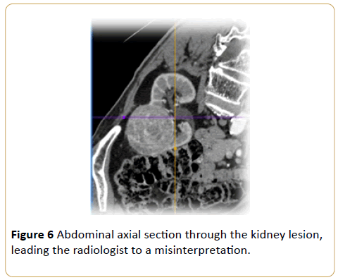 Archives-Cancer-Research-Abdominal-axial-kidney-lesion