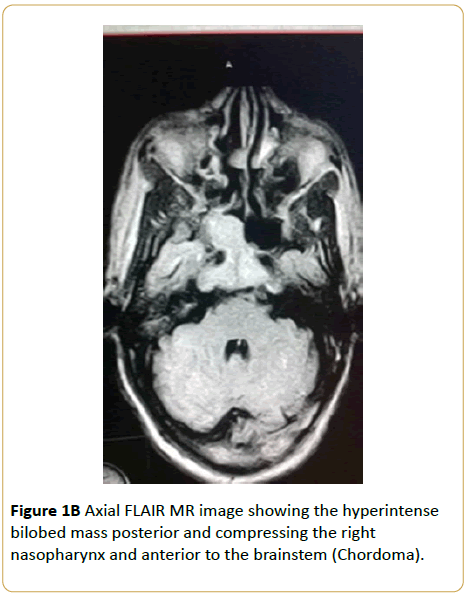 Archives-Cancer-Research-Axial-FLAIR