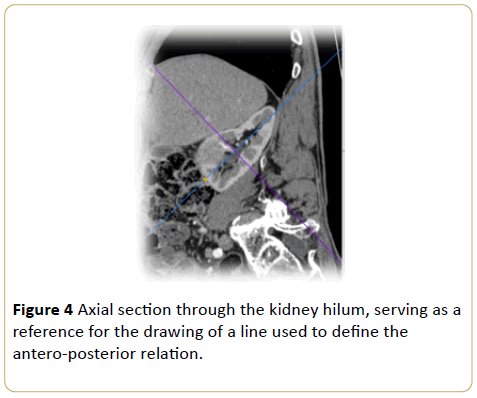 Archives-Cancer-Research-Axial-kidney-hilum