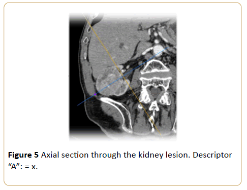 Archives-Cancer-Research-Axial-kidney-lesion