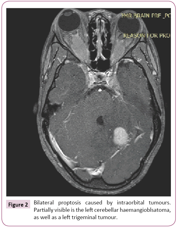 Archives-Cancer-Research-Bilateral-proptosis