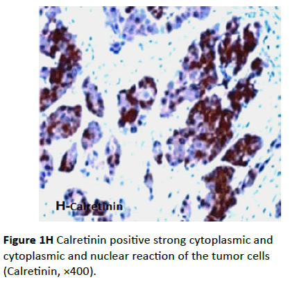 Archives-Cancer-Research-Calretinin-positive-strong