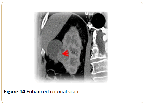Archives-Cancer-Research-Enhanced-coronal-scan