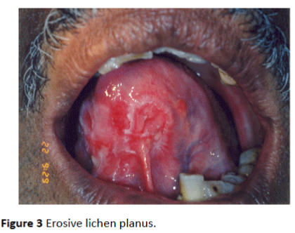 Archives-Cancer-Research-Erosive-lichen