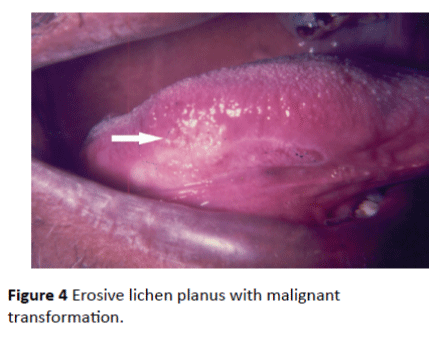 Archives-Cancer-Research-Erosive-lichen