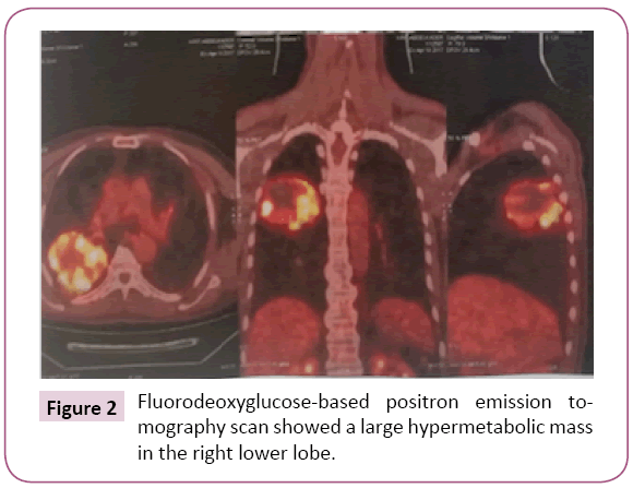 Archives-Cancer-Research-Fluorodeoxyglucose-based