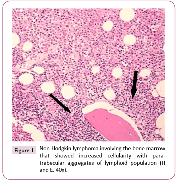 Archives-Cancer-Research-Hodgkin-lymphoma