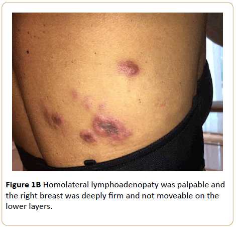 Archives-Cancer-Research-Homolateral-lymphoadenopaty