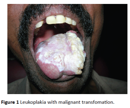 Archives-Cancer-Research-Leukoplakia