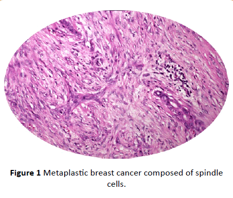 Archives-Cancer-Research-Metaplastic-breast